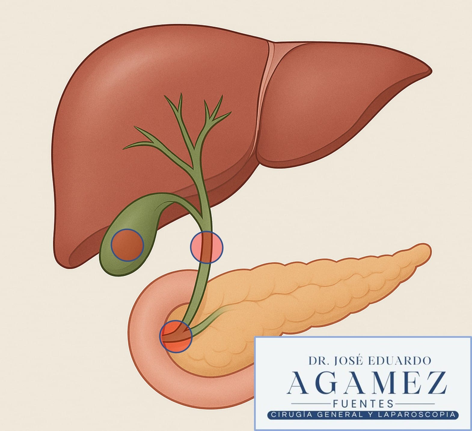 Diagrama del procedimiento laparoscópico de colecistectomía