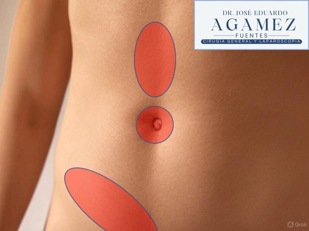 Reparación laparoscópica de hernia inguinal en Medellín con cirugía robótica Da Vinci