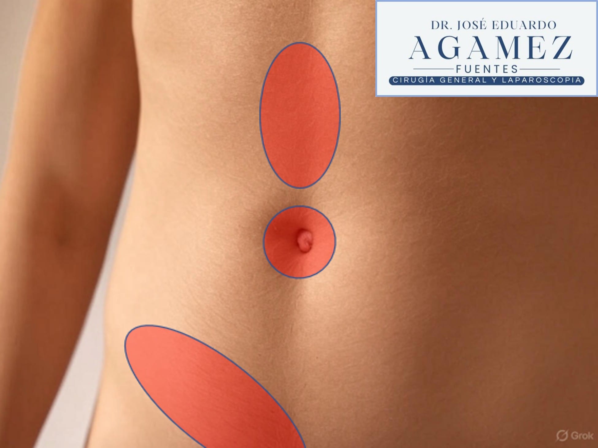 Hernias de pared abdominal, umbilical, epigastrica, inguinal e incisional, tratadas por el Dr. José Agamez