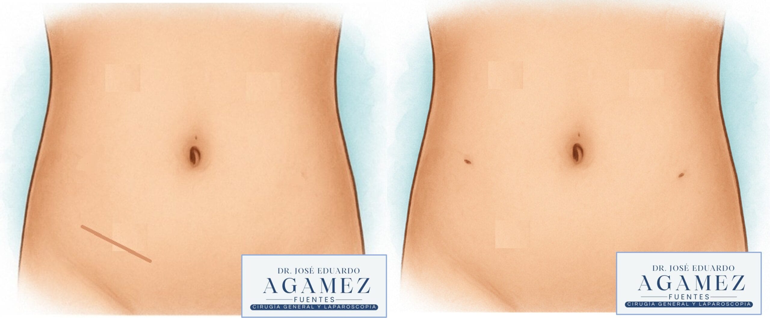 Comparación cicatriz cirugia abierta vs minima invasión