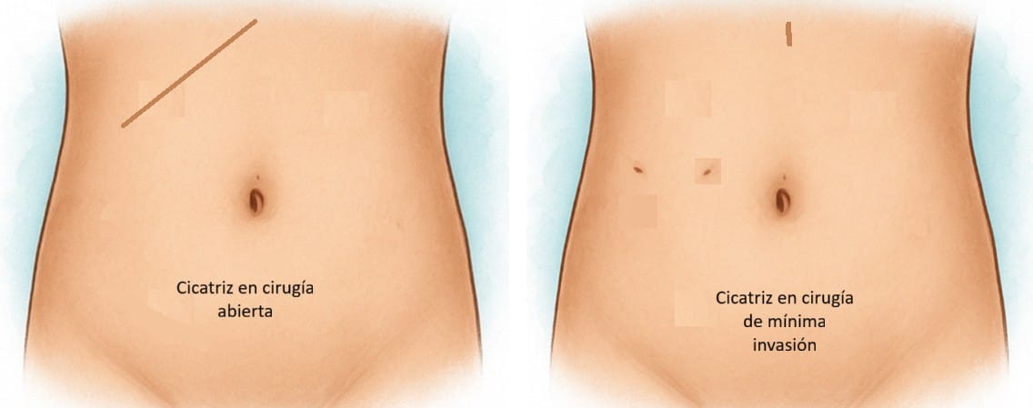 Imagen comparativa de la cicatriz en cirugía abierta y laparoscópica de vesícula